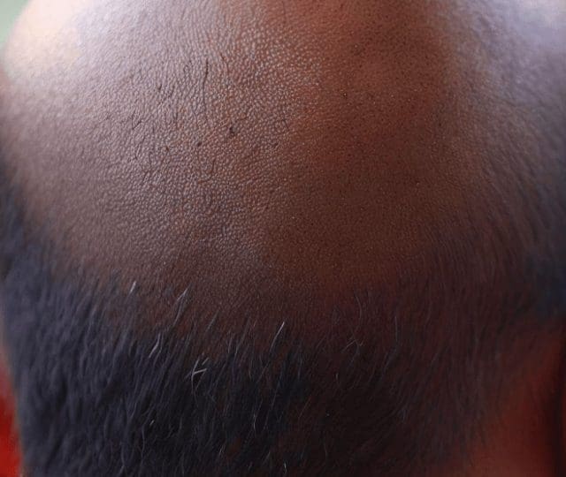 Quais são os efeitos colaterais do minoxidil?