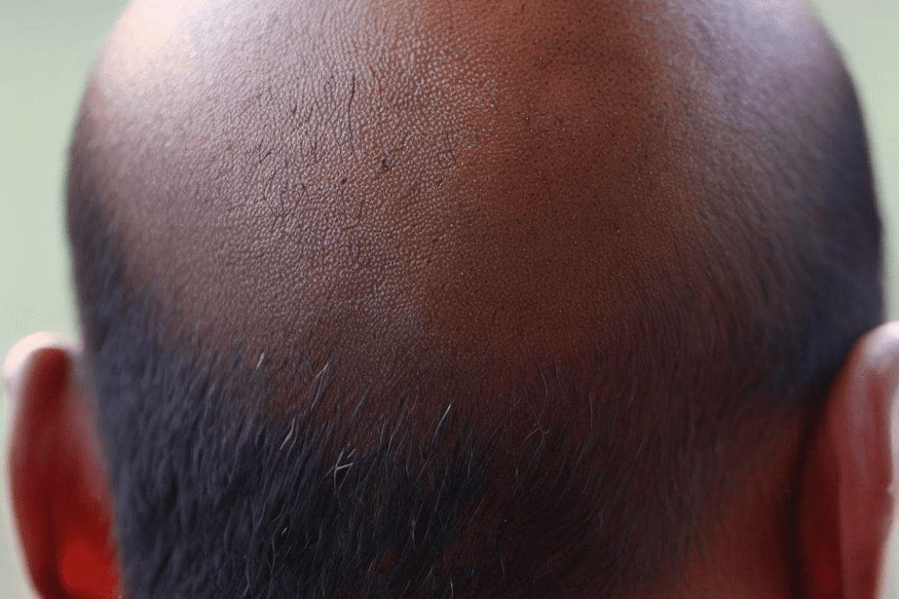 Quais são os efeitos colaterais do minoxidil?