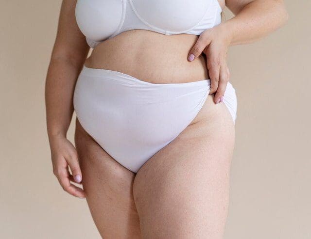 Lipedema: conheça a condição que afeta milhões de mulheres no mundo